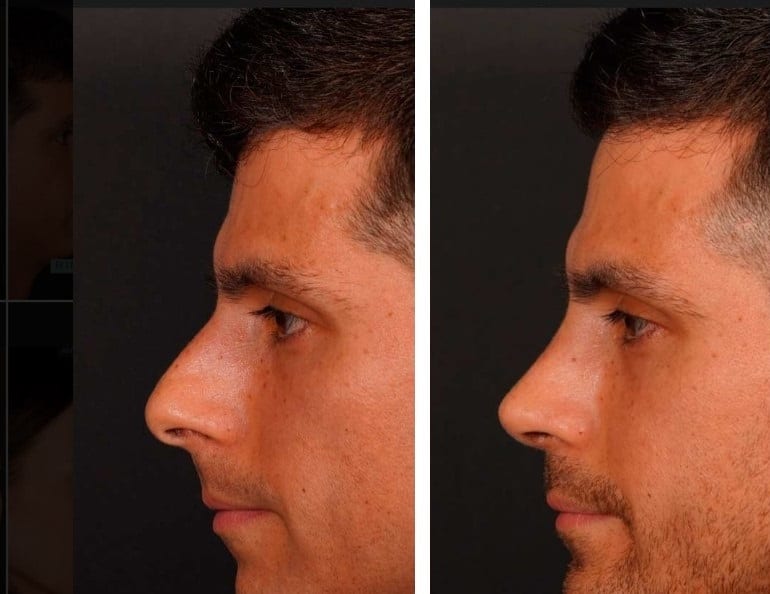 Rinoplastia caso 26 — antes y después